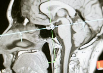 Close-up of an MRI scan showing a sagittal view of the human brain for analysis.