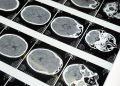 Detailed brain MRI scans displayed on a lightbox, showcasing medical imaging techniques.