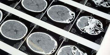 Detailed brain MRI scans displayed on a lightbox, showcasing medical imaging techniques.