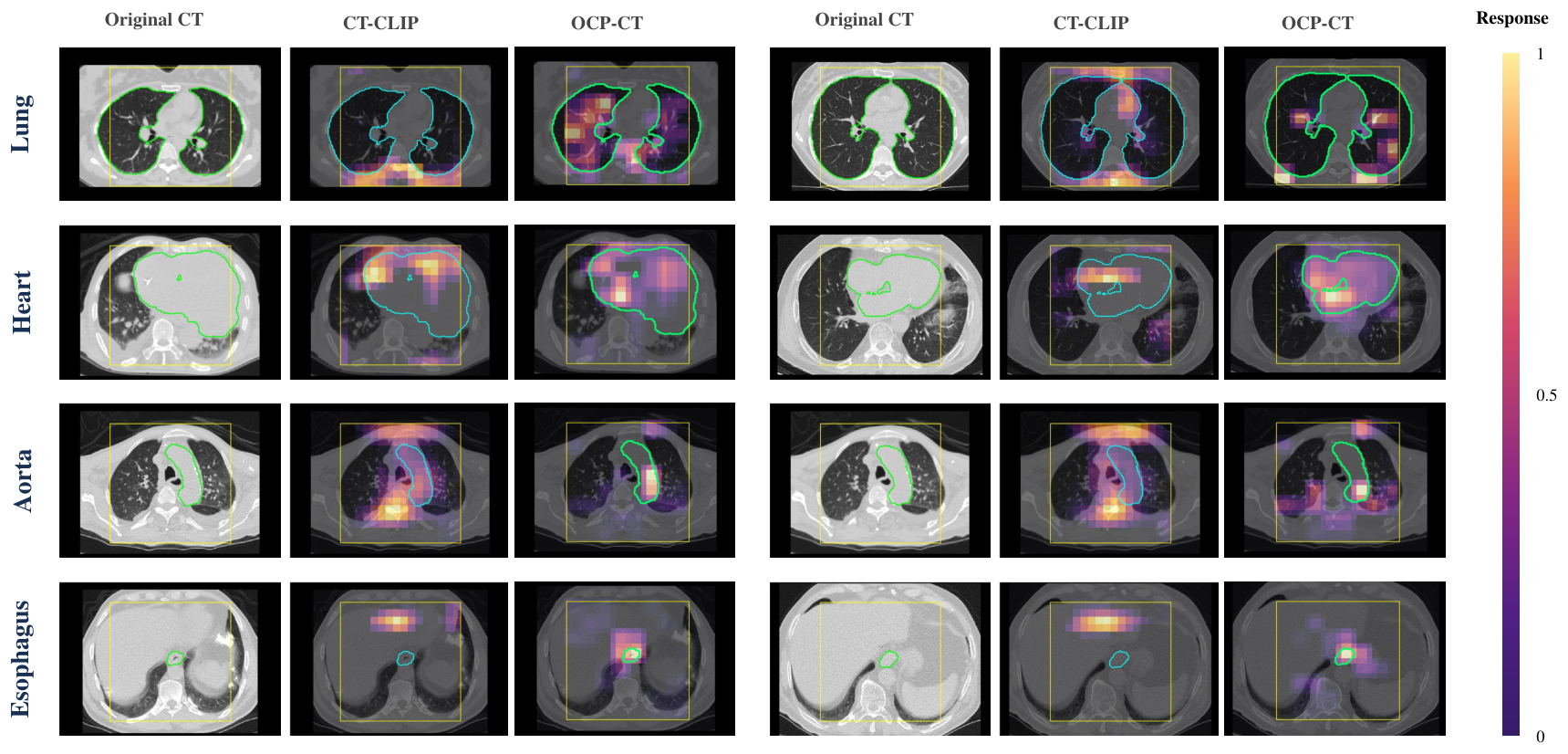 기관별 패턴 토큰으로 CT-보고서 사전학습한 OCP-CT, 두 공개 벤치마크 제로샷 진단 성능 확인 논문의 Figure 4