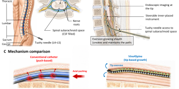 2mm 자가전개 로봇, 인체 척수 지주막하강 모사·시신 검증에서 마찰과 접촉력을 낮추며 150mm 전진 논문의 Figure 1