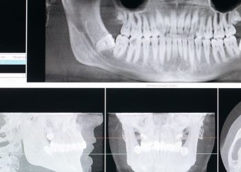 파노라마 치과 엑스레이와 3D 단층 영상