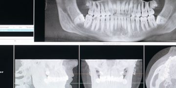 파노라마 치과 엑스레이와 3D 단층 영상
