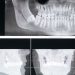 파노라마 치과 엑스레이와 3D 단층 영상