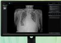 흉부 X-ray 예비소견서를 표시한 딥노이드 M4CXR 제품 화면