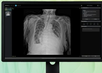 흉부 X-ray 예비소견서를 표시한 딥노이드 M4CXR 제품 화면