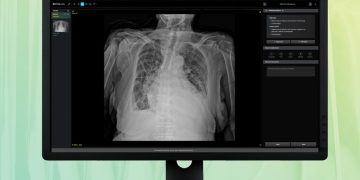 흉부 X-ray 예비소견서를 표시한 딥노이드 M4CXR 제품 화면