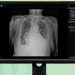 흉부 X-ray 예비소견서를 표시한 딥노이드 M4CXR 제품 화면